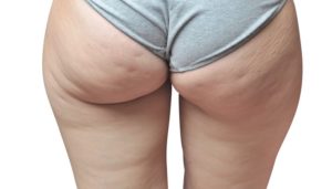 La cellulite si associa a cattiva circolazione e spesso alla comparsa di vene visibili sulle gambe