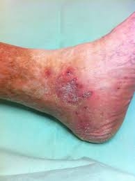 Le ulcere alle gambe possono essere causate da insufficienza venosa