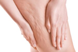 tra i rimedi per la cellulite la carbossiterapia ha un ruolo importante