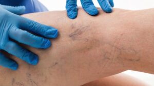 La scleroterapia dei capillari permette di migliorare l'aspetto delle gambe