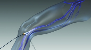 Inserimento della fibra laser nella safena