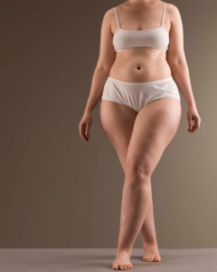 La presenza di gambe grosse può essere dovuta al lipedema