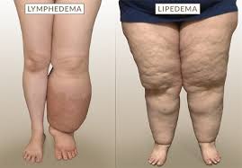 Differenza fra lipedema e linfedema