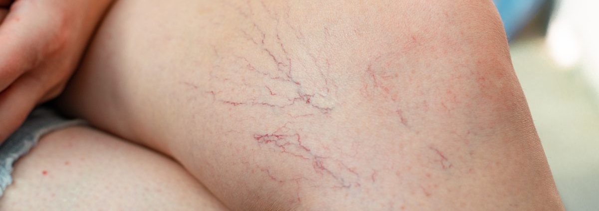 Ci sono tre rimedi efficaci per trattare i capillari rotti sulle gambe